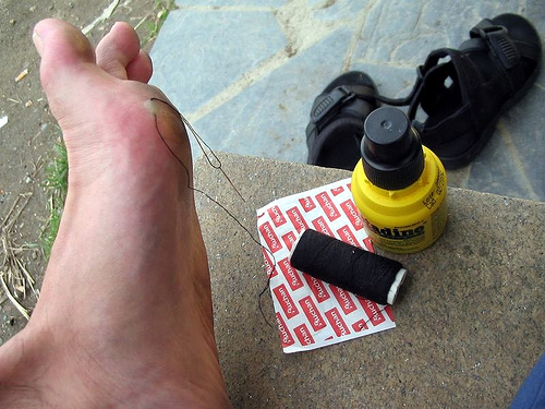 M_todo_para_curar_ampollas_en_los_pies